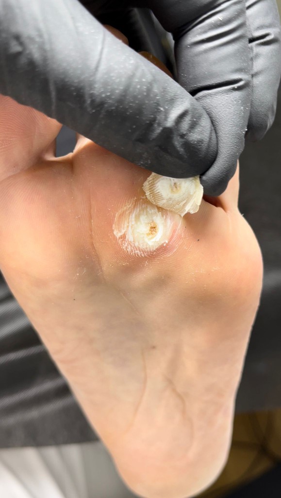 Профессиональная обработка утолщения на стопе — уход во время лечения