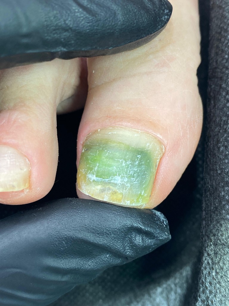 Изменение цвета ногтевой пластины