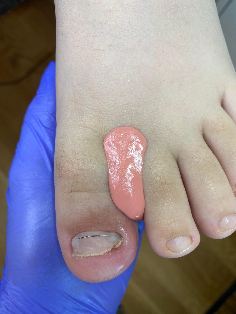 Коррекция ногтя и индивидуальный межпальцевый разделитель