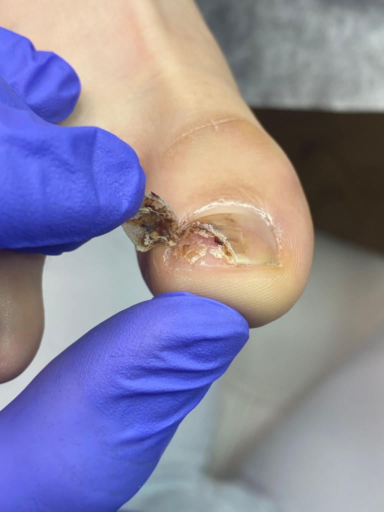 Отслоение от ложа и подногтевое содержимое