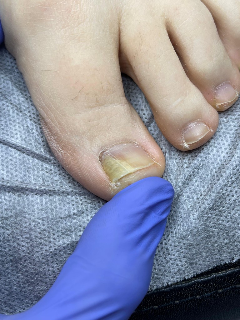 Изменение цвета и отслоение от ложа