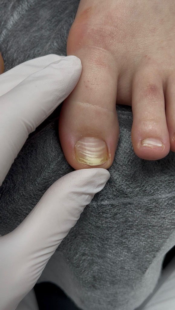 Утолщение, борозды и изменение цвета ногтевой пластины — осмотр